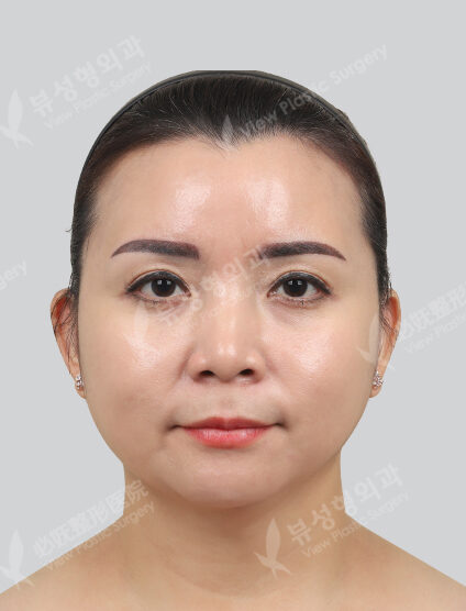 Forehead, forehead, corner of mouth, eye area Botox, contour injection (1 month) — Before