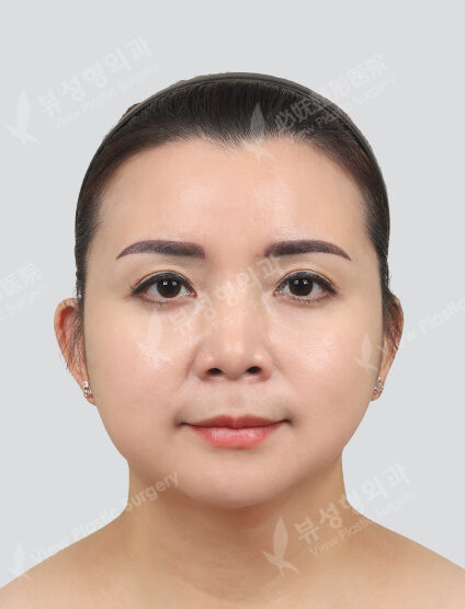 Forehead, forehead, corner of mouth, eye area Botox, contour injection (1 month) — After