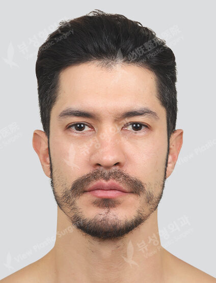 Shrink, skin botox, uvula, dot, co2 (1 month) — After