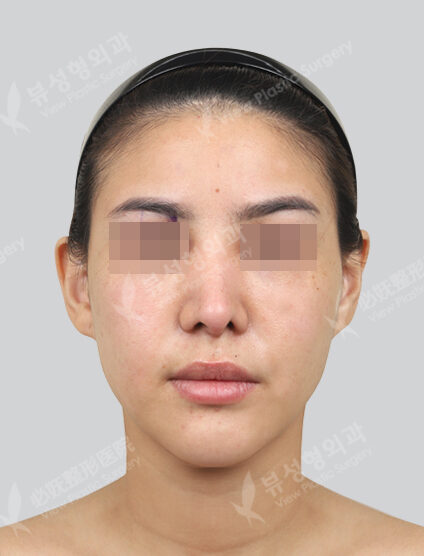 Rejuran Healer + Skin Botox (1 month) — Before
