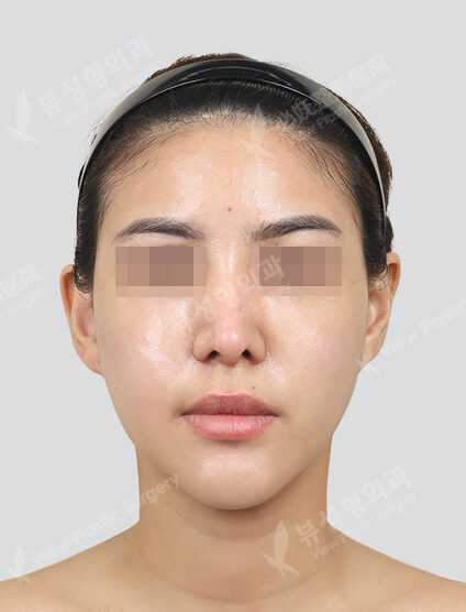 Rejuran Healer + Skin Botox (1 month) — After