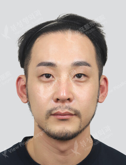 Shrink+Forehead, Botox for forehead (1 month) — After