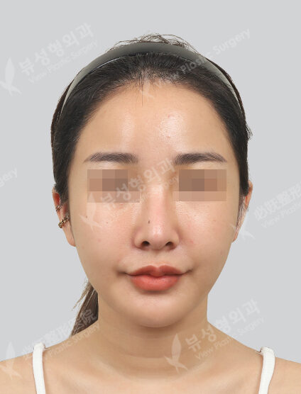 Vivace, PDRN (1 month) — Before