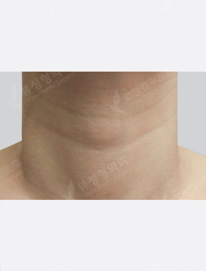 Neck Wrinkle Filler (1 month) — Before