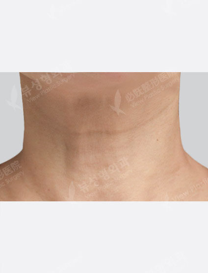 Neck Wrinkle Filler (1 month) — Before