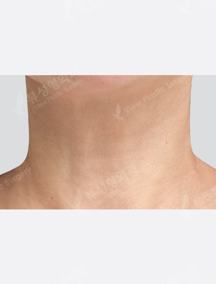 Neck Wrinkle Filler (1 month) — After