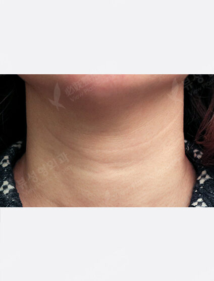Neck Wrinkle Filler (1 month) — Before