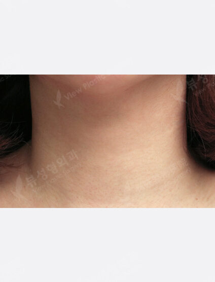 Neck Wrinkle Filler (1 month) — After