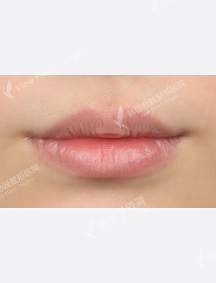 Lip filler (1 month) — Before