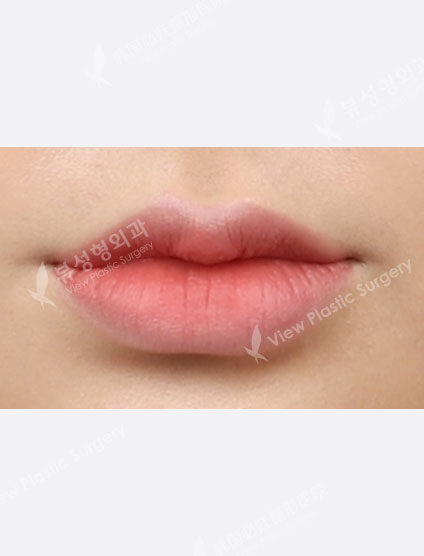 Lip filler (1 month) — After