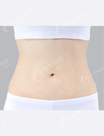Liposuction (Abdomen+Love Handles)(9 Months) — After