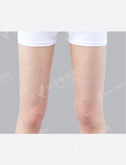 Liposuction Thigh (9 Months) — After