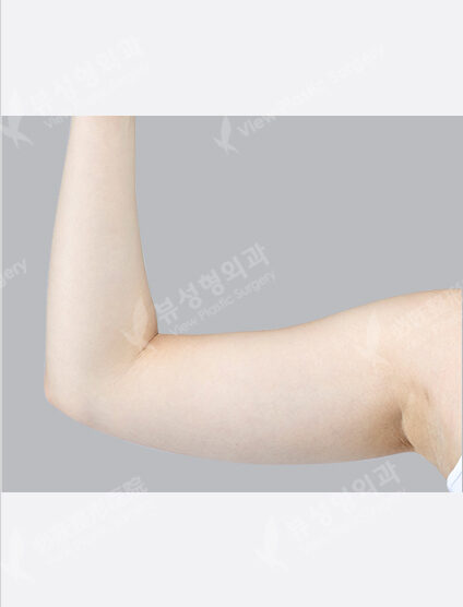 Liposuction(9 Months) — Before