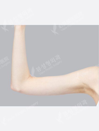 Liposuction(9 Months) — After