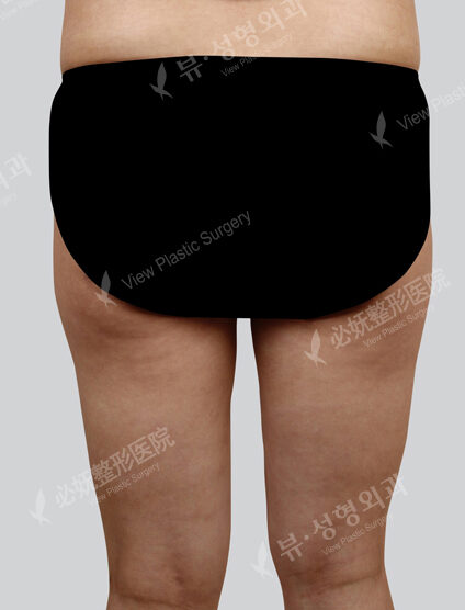 Liposuction Thigh (1 Months) — Before