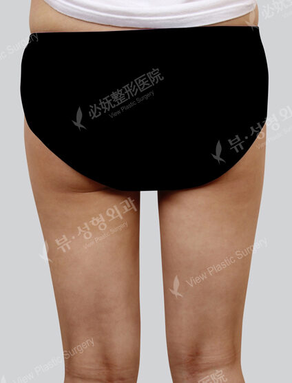 Liposuction Thigh (1 Months) — After