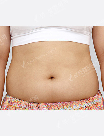 Liposuction Abdomen (2 Months) — Before