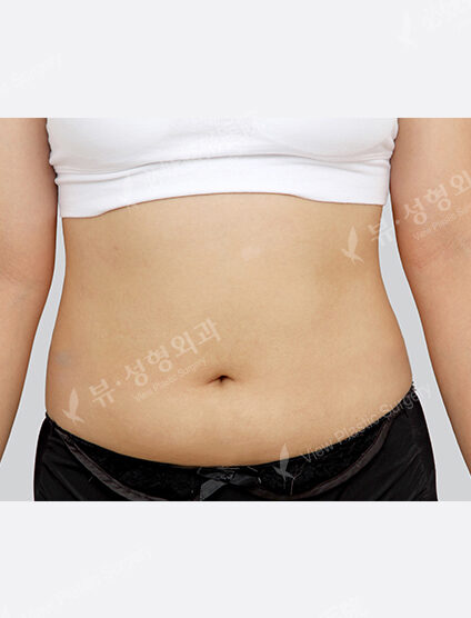 Liposuction Abdomen (2 Months) — After
