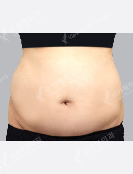 Liposuction (Abdomen+Flank+Love Handles +)(3 Months) — Before