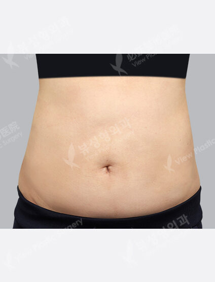 Liposuction (Abdomen+Flank+Love Handles +)(3 Months) — After