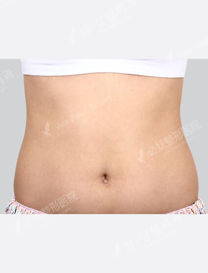 Liposuction Abdomen (1 Months) — Before