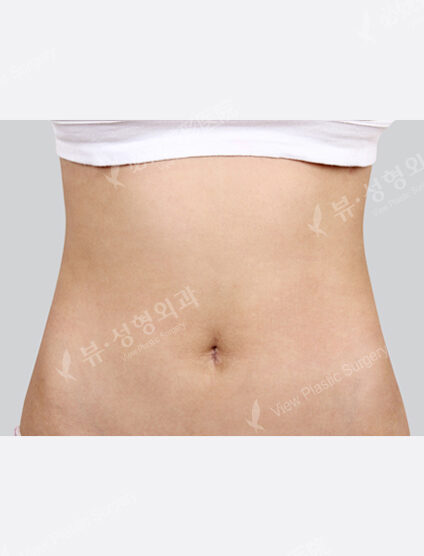 Liposuction Abdomen (1 Months) — After