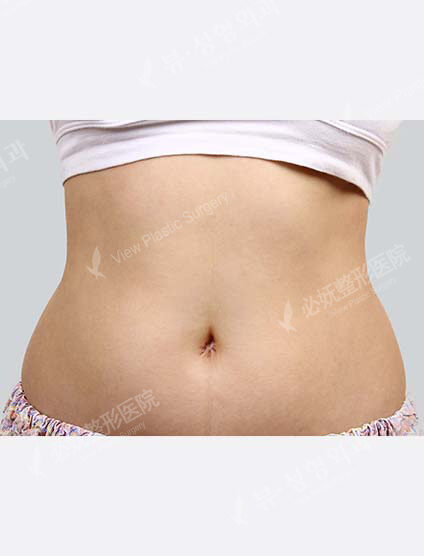 Liposuction Abdomen (1 Months) — Before