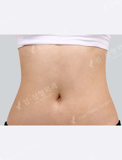 Liposuction Abdomen (1 Months) — After