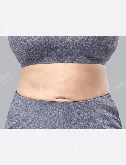 Liposuction (Abdomen)(3 Months) — After