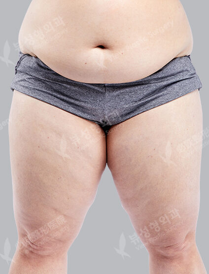 Liposuction (Thigh)(3 Months) — Before