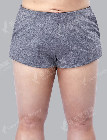 Liposuction (Thigh)(3 Months) — After
