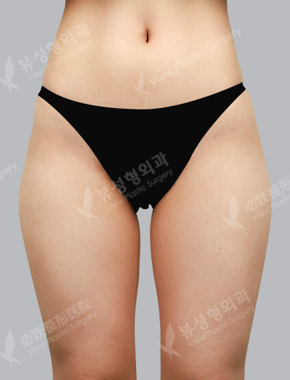 Fat Graft (3 Months) — Before