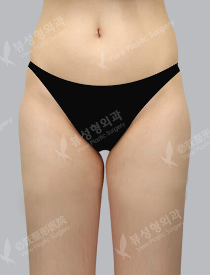 Fat Graft (3 Months) — Before