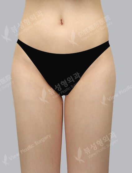 Fat Graft (3 Months) — After