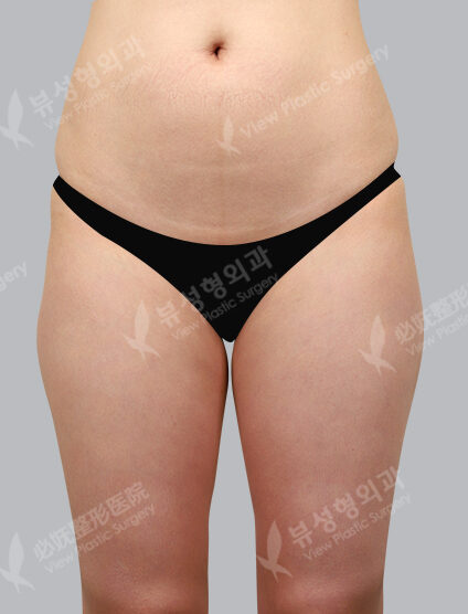 Fat Graft (3 Months) — Before