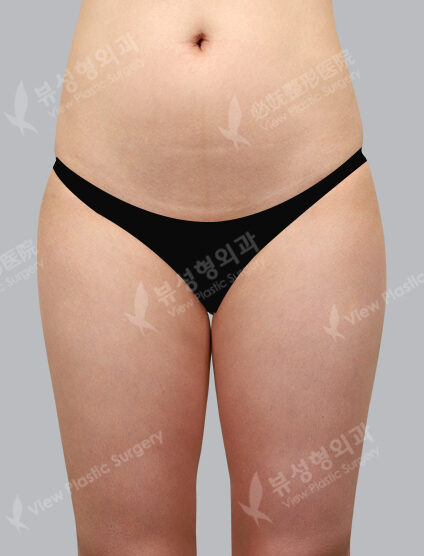 Fat Graft (3 Months) — After