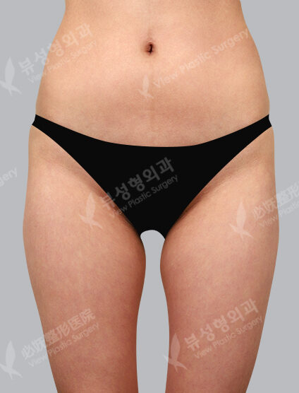 Fat Graft (3 Months) — Before