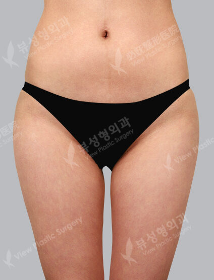 Fat Graft (3 Months) — After