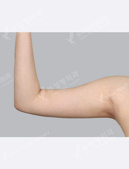 Liposuction (+ Flank+Love Handles3 Months) — After
