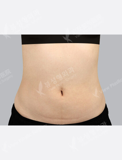 Liposuction (Abdomen3 Months) — After