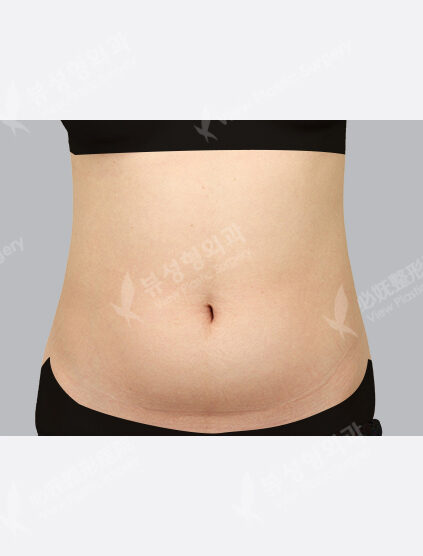 Liposuction (Abdomen3 Months) — Before