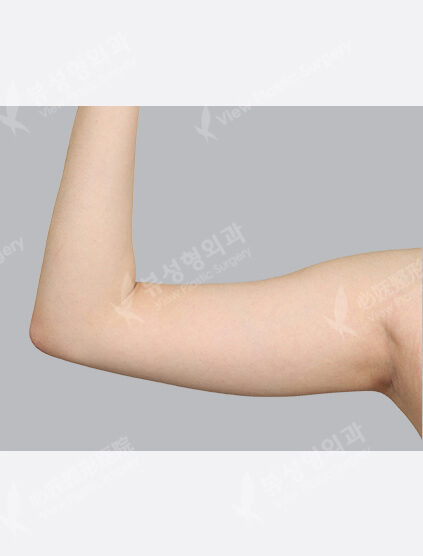 Liposuction (+ Flank+Love Handles3 Months) — Before