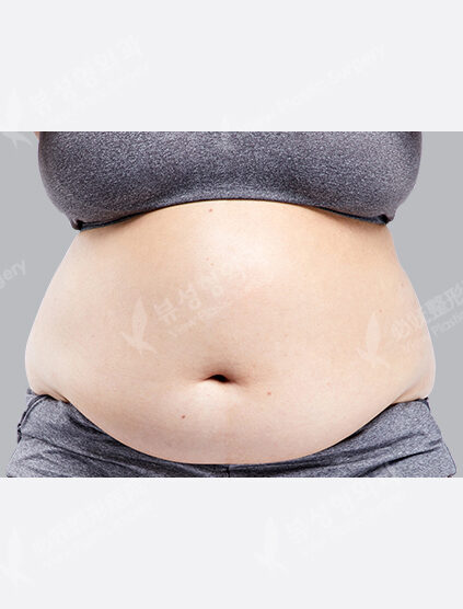 Liposuction (Abdomen)(3 Months) — Before