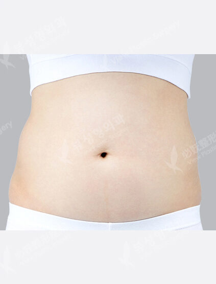 Liposuction (Abdomen+Love Handles)(9 Months) — Before