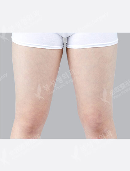 Liposuction Thigh (9 Months) — Before