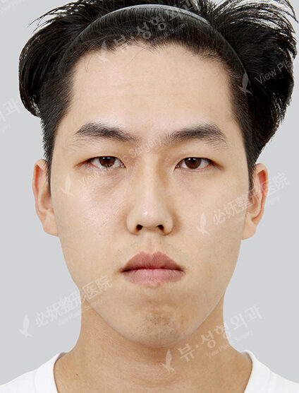 Nano Two Jaw+Natural Vline+Zygoma Reduction+Fat Graft (4 Months) — Before