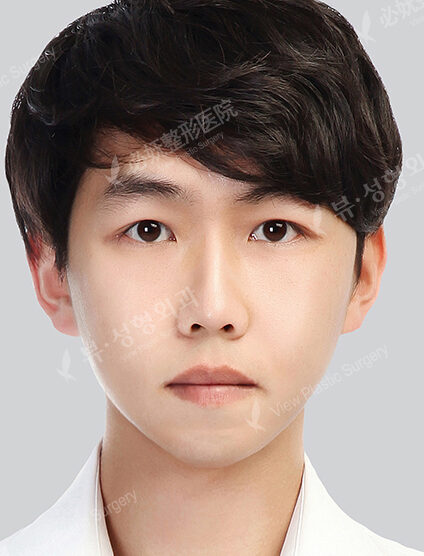 Nano Two Jaw+Natural Vline+Zygoma Reduction+Fat Graft (4 Months) — After