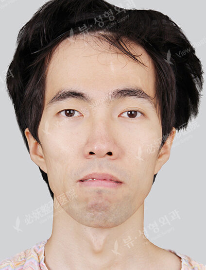 Protruding Mouth+Natural Vline+Zygoma Reduction+T.O.P Surgery+Forehead Implant (4 Months) — Before