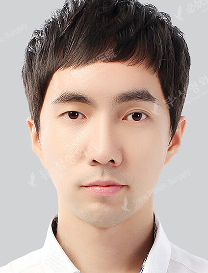 Protruding Mouth+Natural Vline+Zygoma Reduction+T.O.P Surgery+Forehead Implant (4 Months) — After