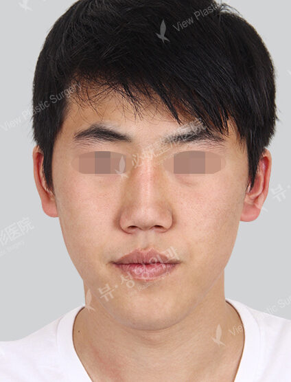 Nano Two Jaw+Natural Vline (6 Months) — Before